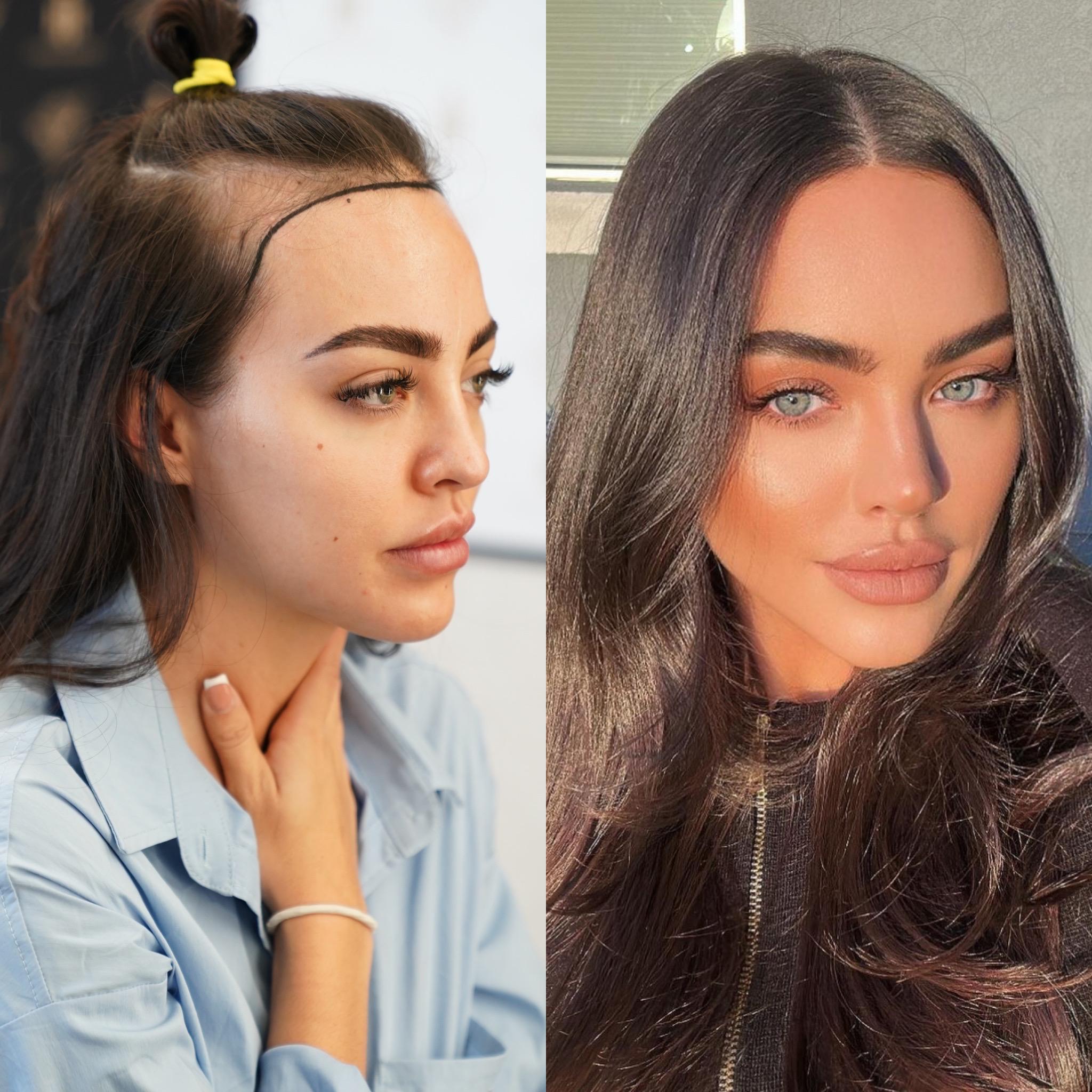 Woman Hair Transplant