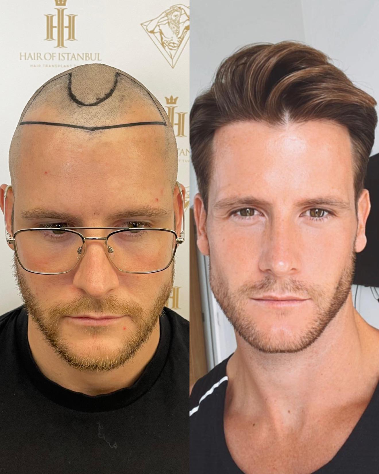 Hair Transplant