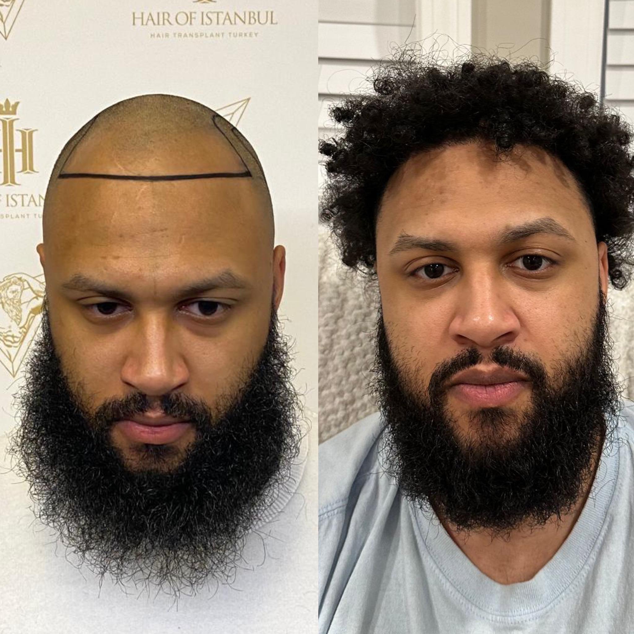 Afro Type Hair Transplant