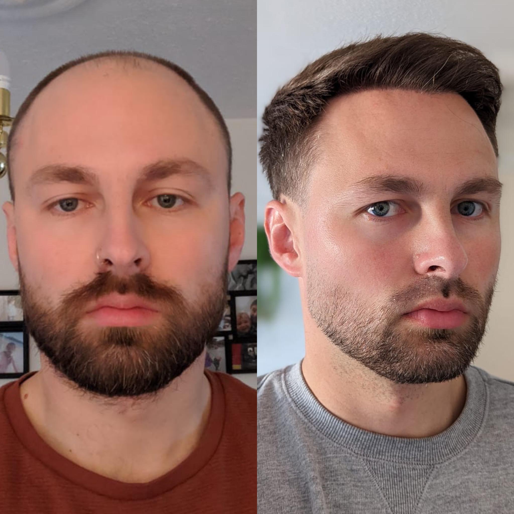 Hair Transplant