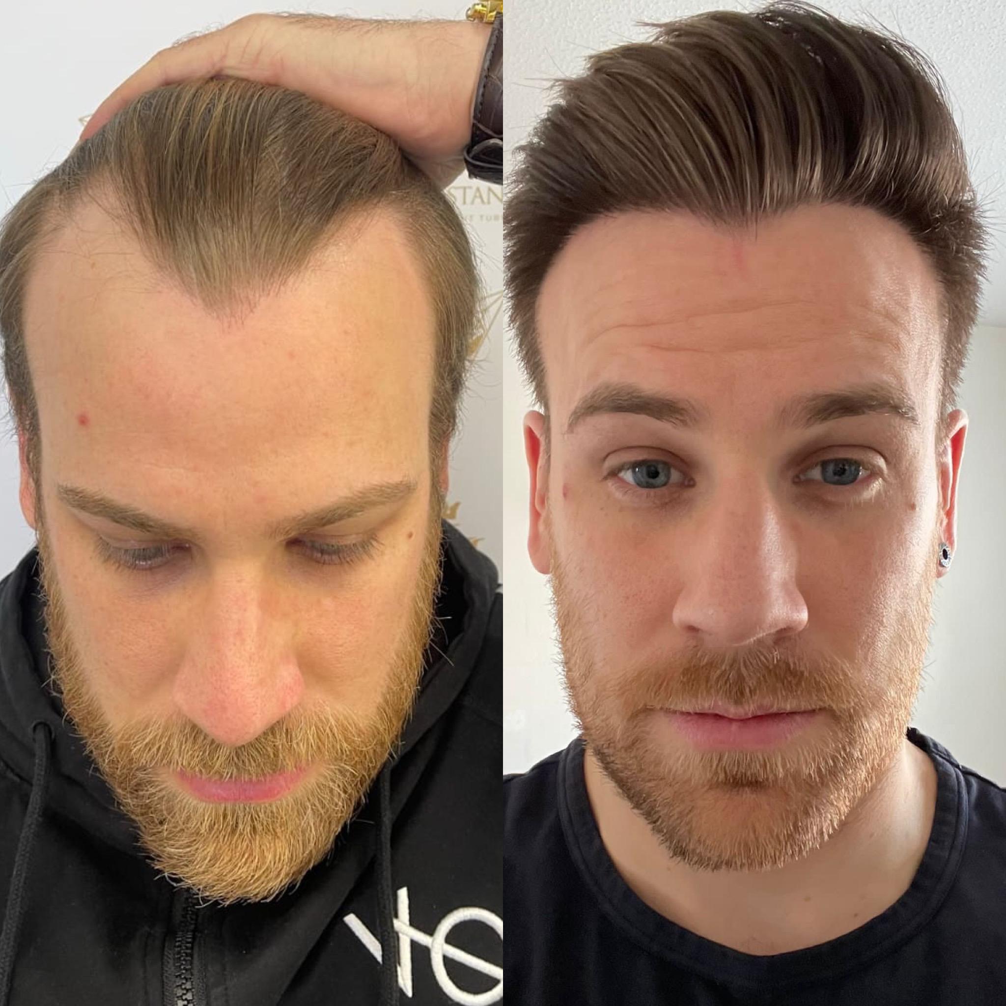 Hair Transplant