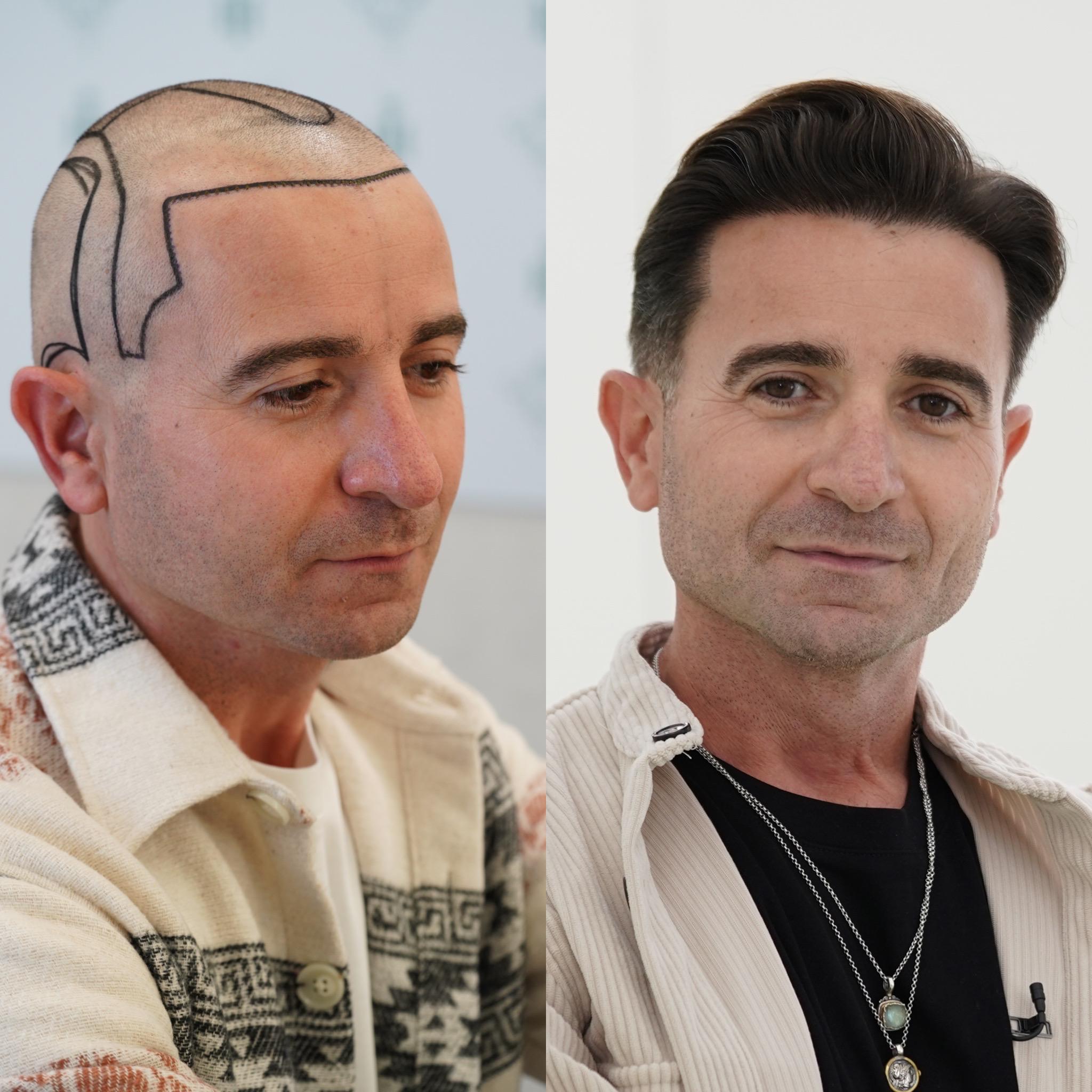 Hair Transplant