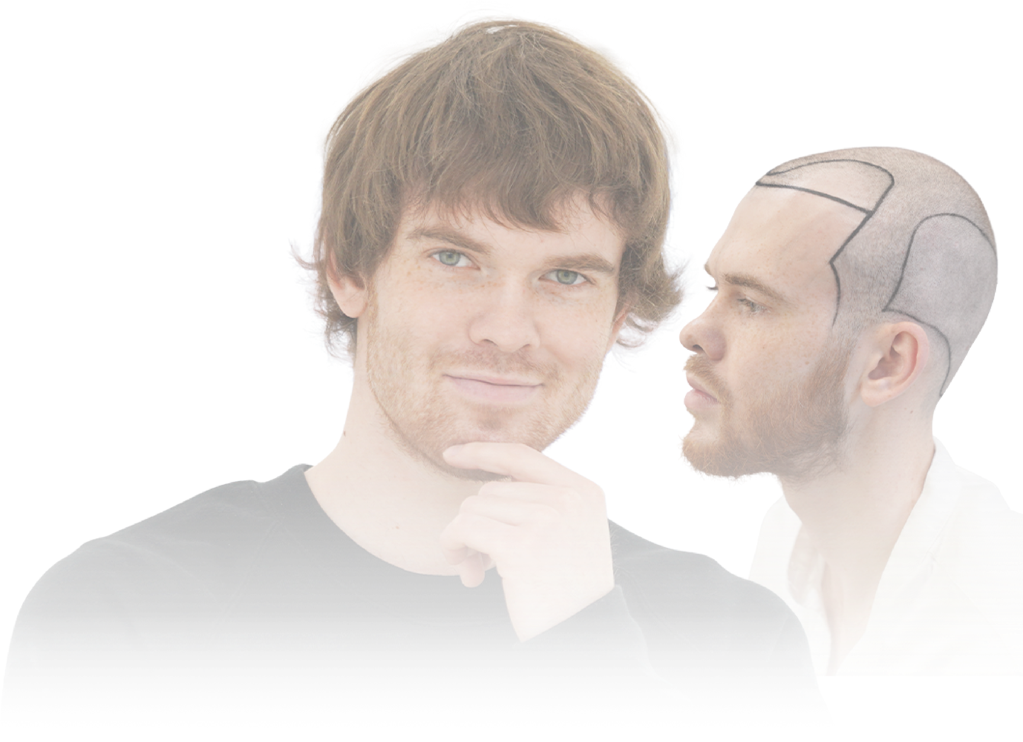 Hair Transplant Before After