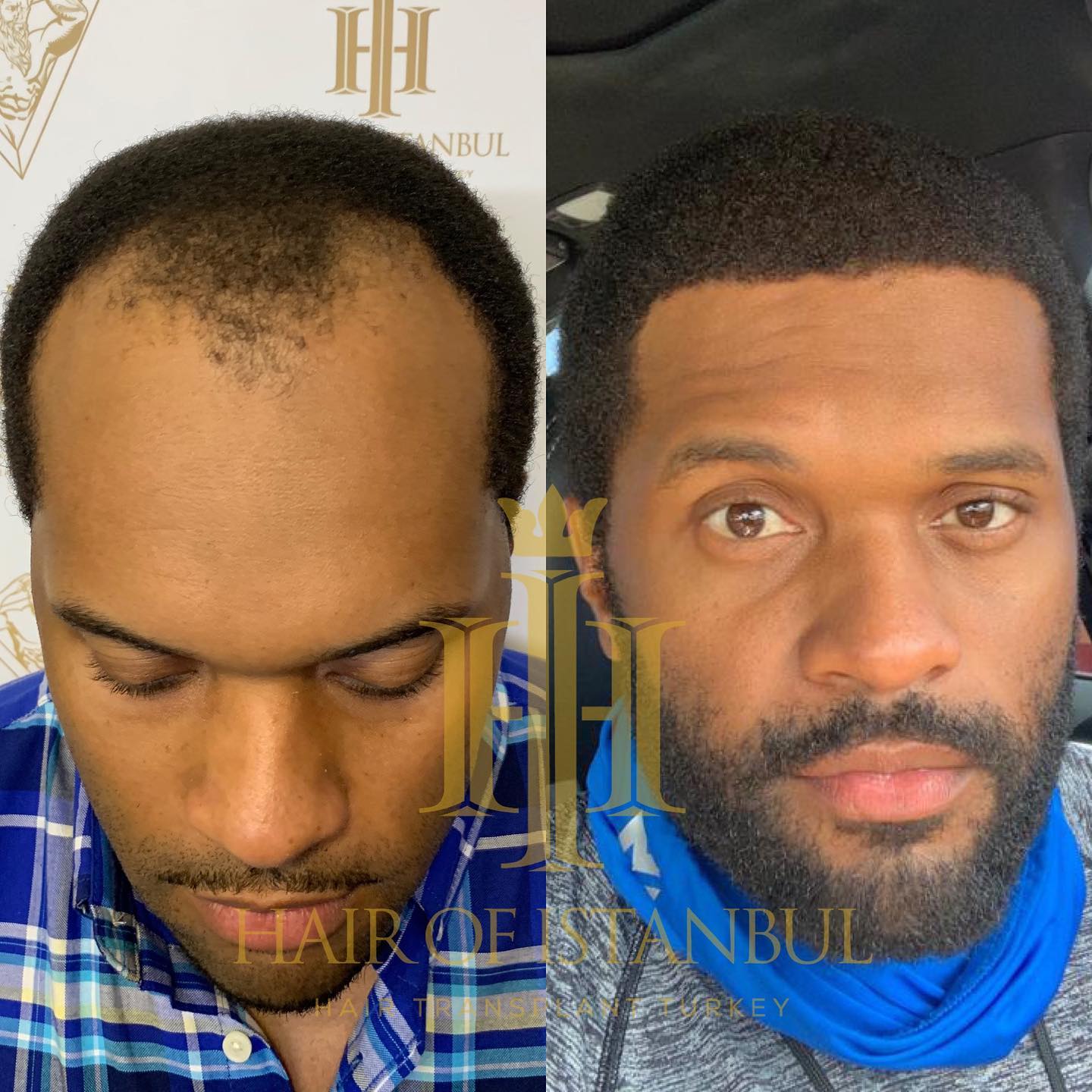 afro hair transplant