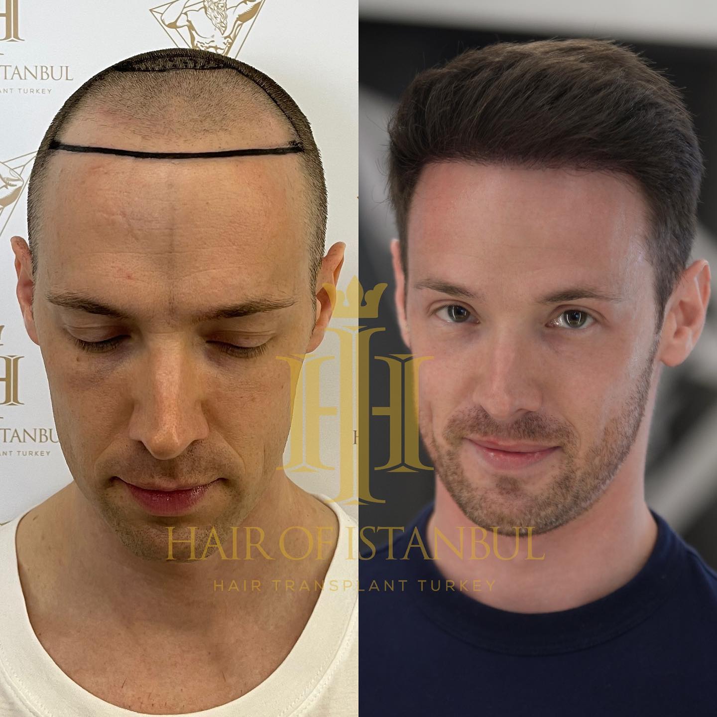 hair transplant