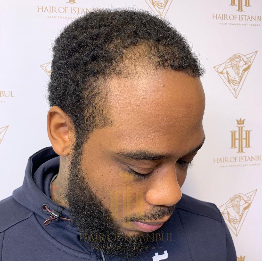 perte de cheveux hoï