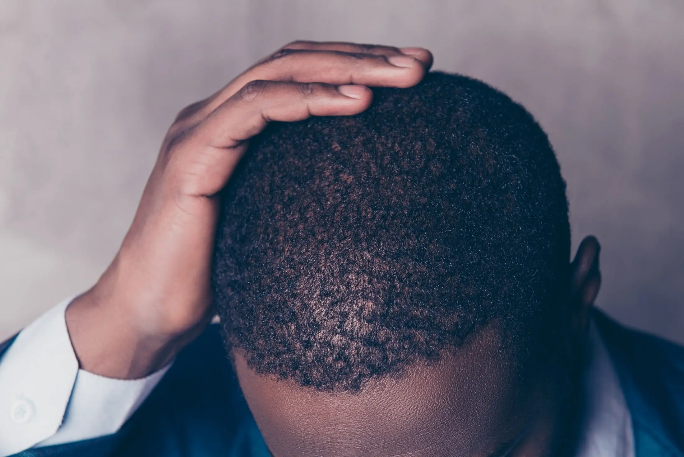A Guide for Afro Hair Transplant