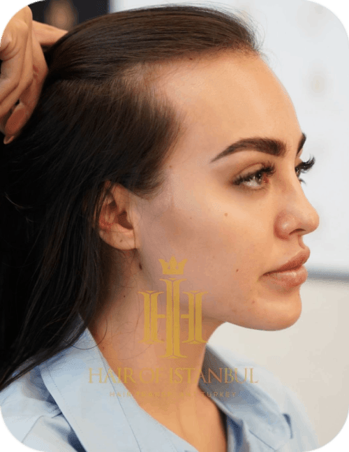 before woman hair transplant