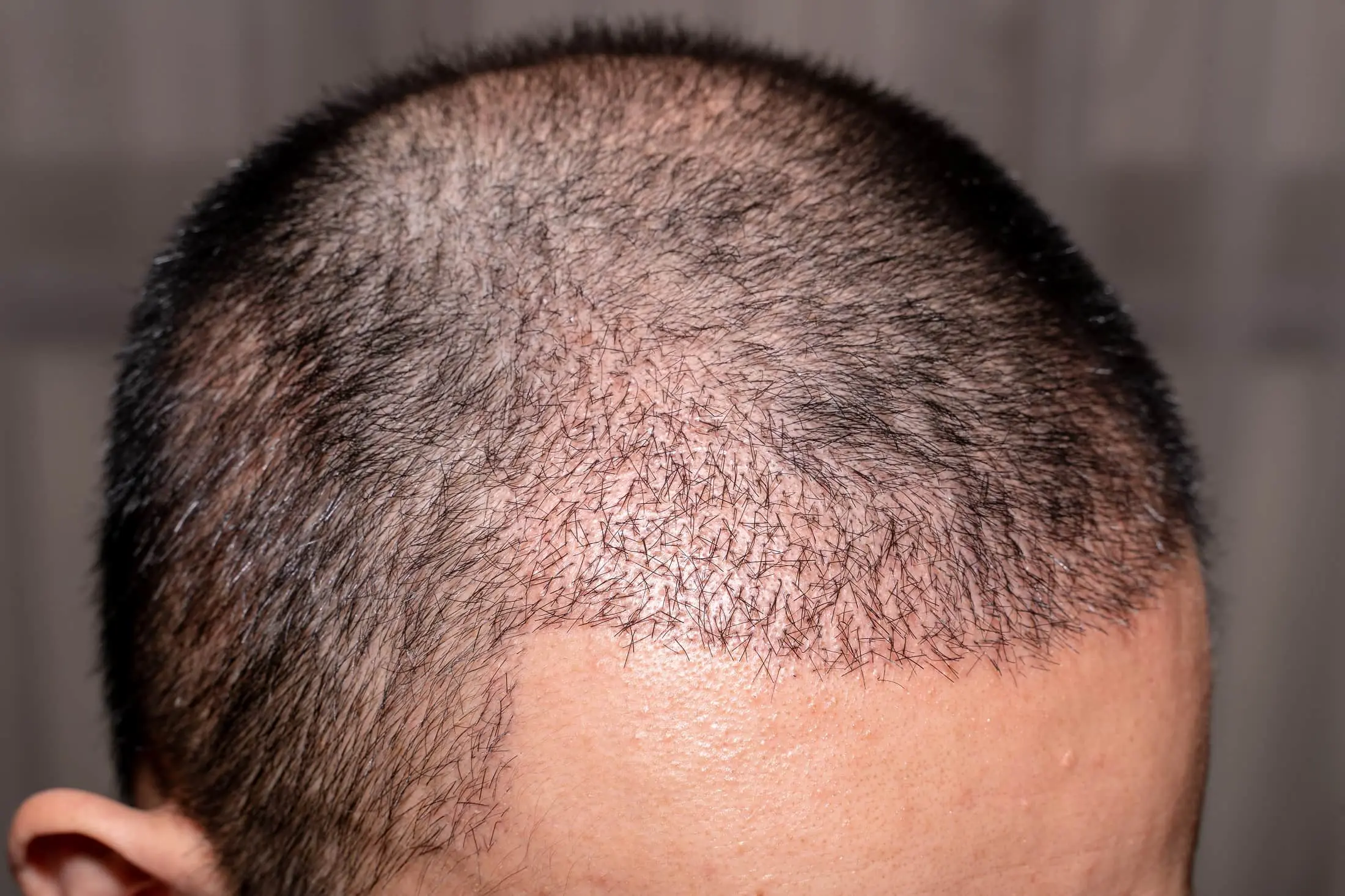 fue hair transplant min
