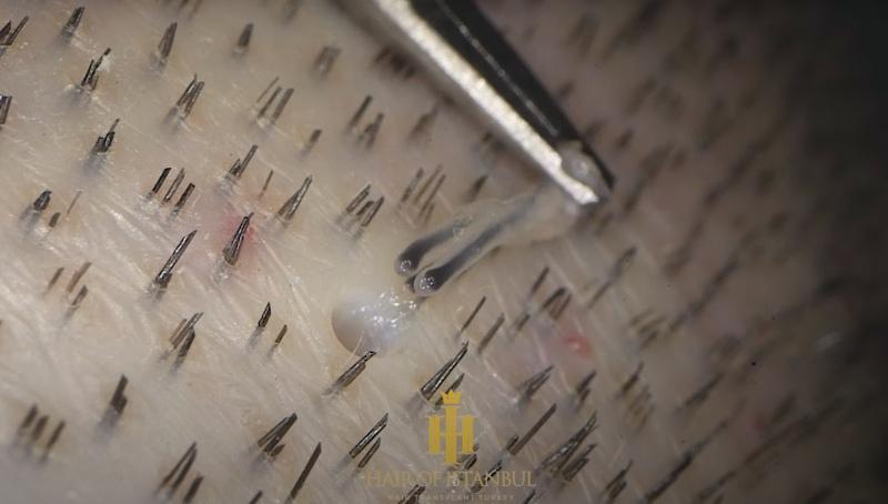 Hair Transplant: A Comprehensive Guide 2 after beard transplant