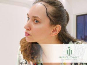 Hair Transplant Cost in UK 2 alın daraltma operasyonu , Forehead Reduction , Réduction du Front , Riduzione della Fronte , Reducción de la Frente , Редукцията на челото
