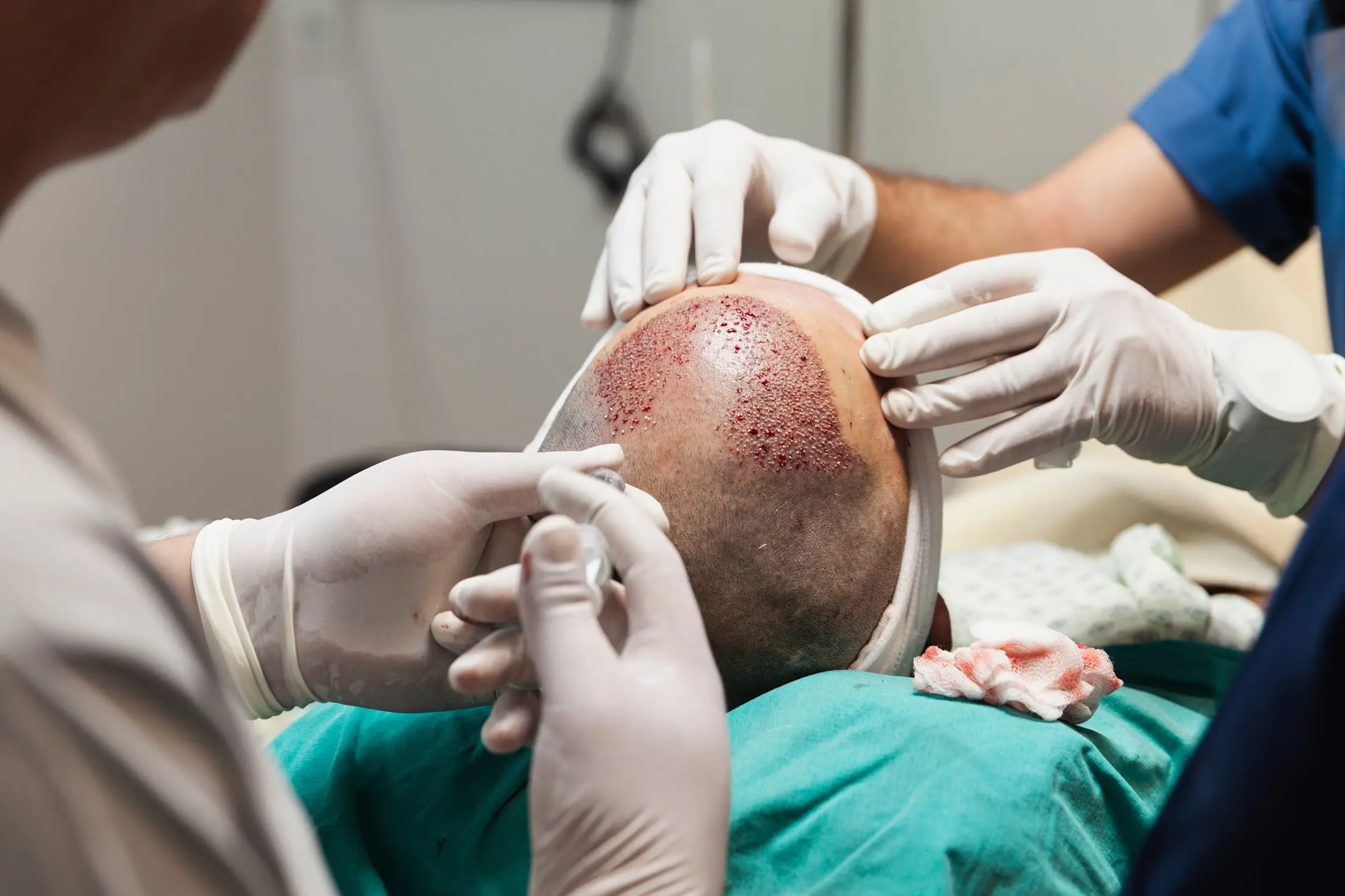 ¿El Trasplante de Cabello es Permanente?