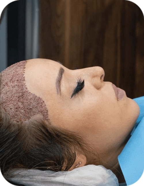 Female Hair Transplant in Turkey  Cost  Procedure  Heva Clinic