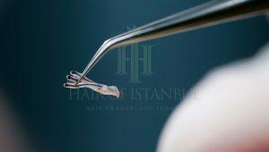 Hair Transplant Methods: Modern Techniques Compared in 2025 5 fue technique lookup