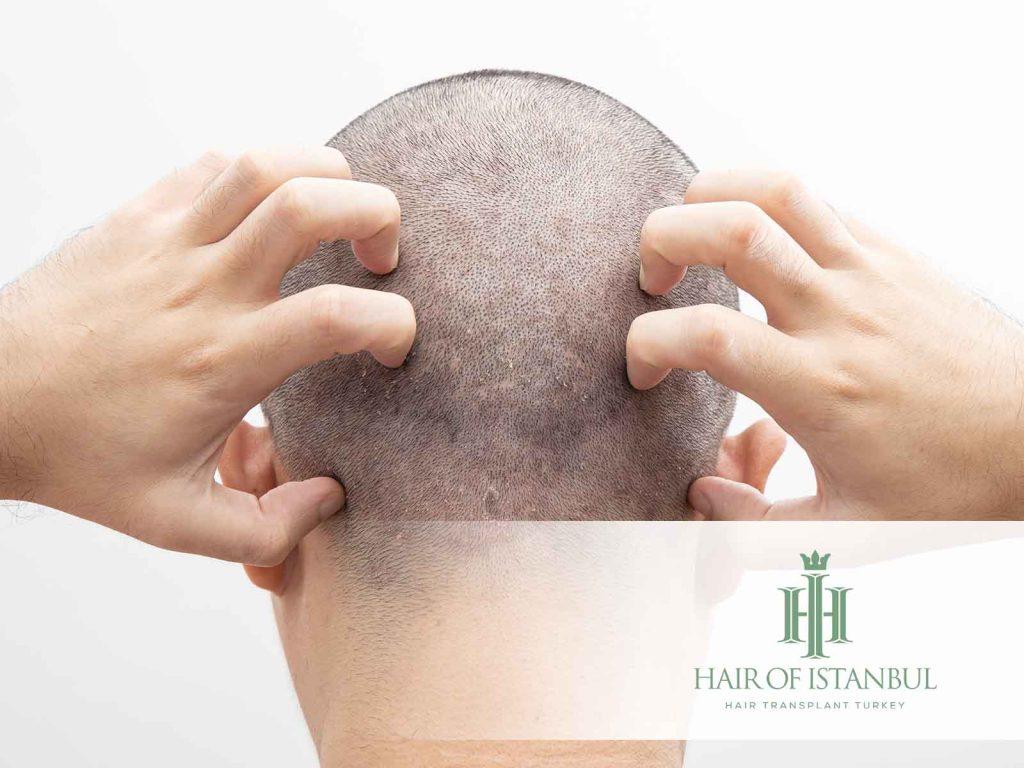 Does Dandruff Cause Hair Loss? Seborrheic Dermatitis and Shedding