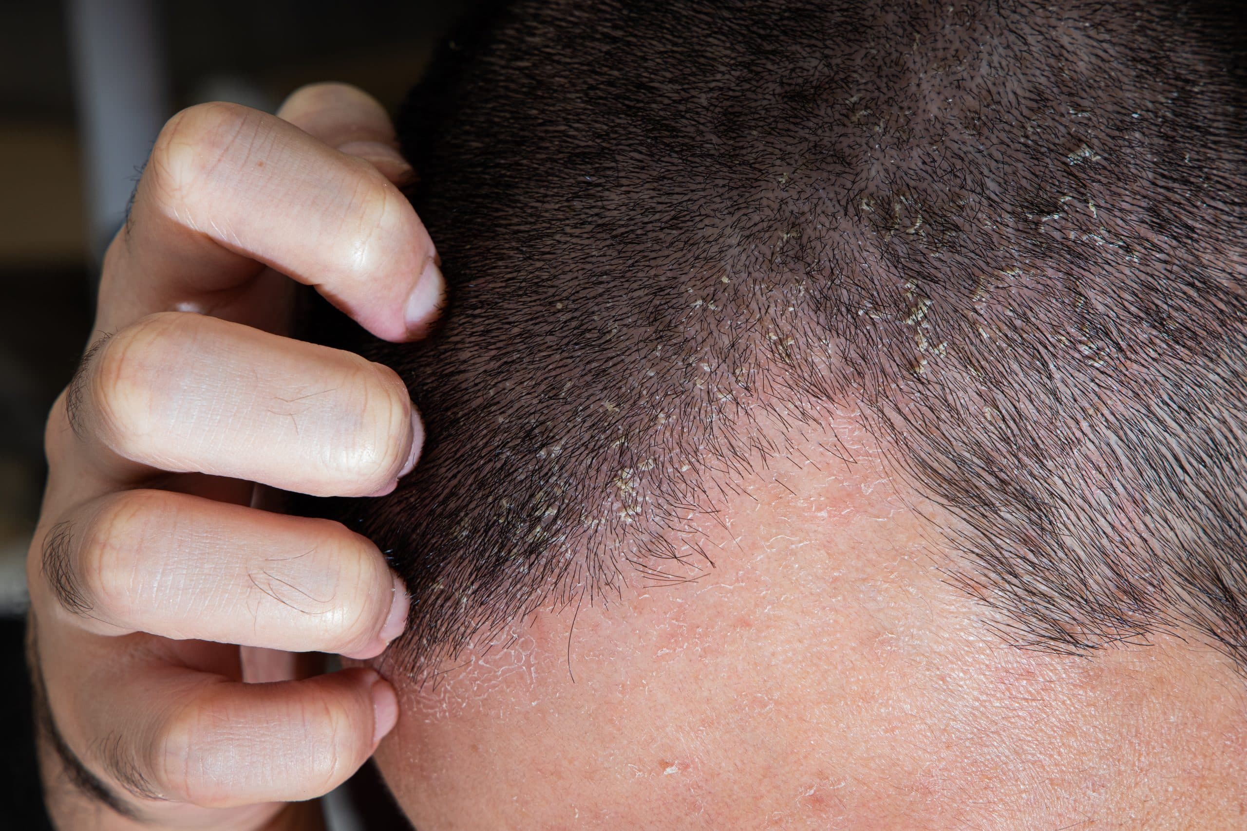 Dermatit, Hair Transplant