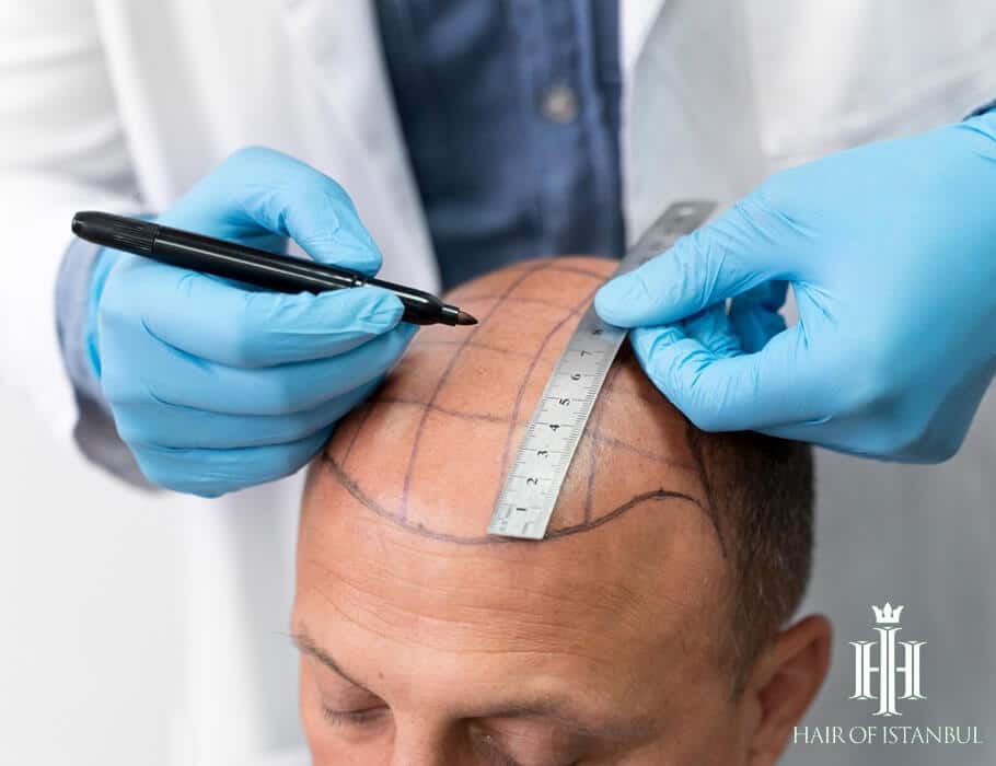 Facing the Fear: How Much Does a Hair Transplant Really Hurt?