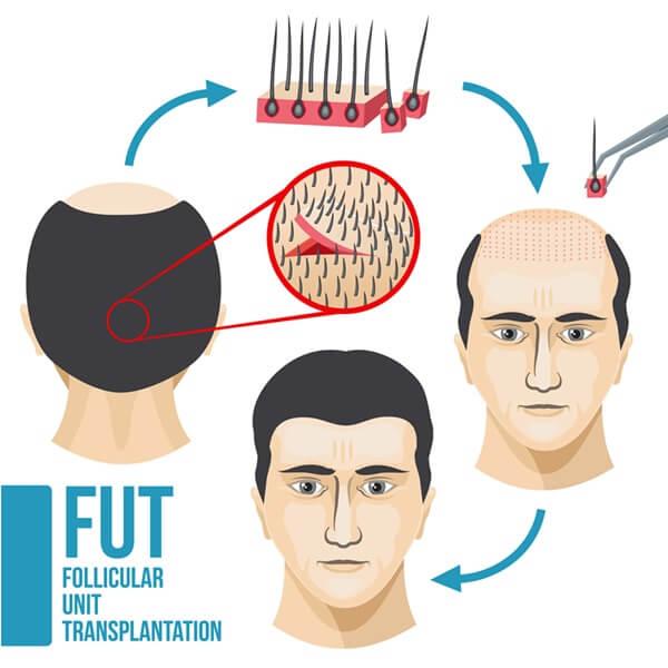 Follicular Unit Transplantation