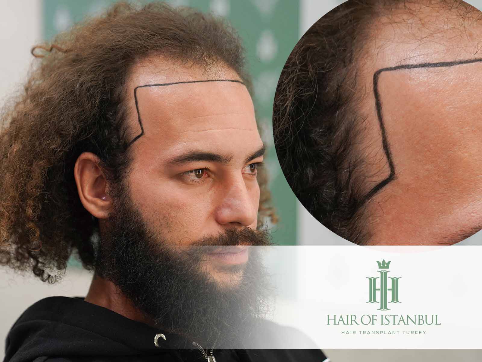 Hair Loss