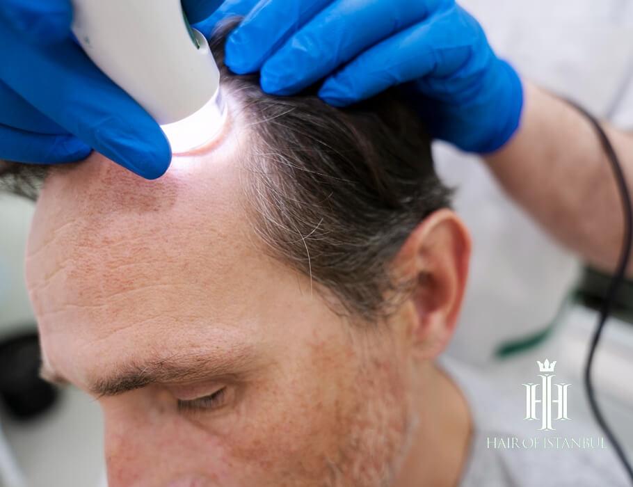 Hair transplantation  Wikipedia