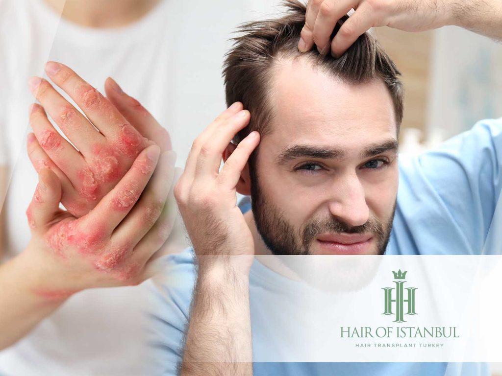 Does Low Testosterone Cause Hair Loss?