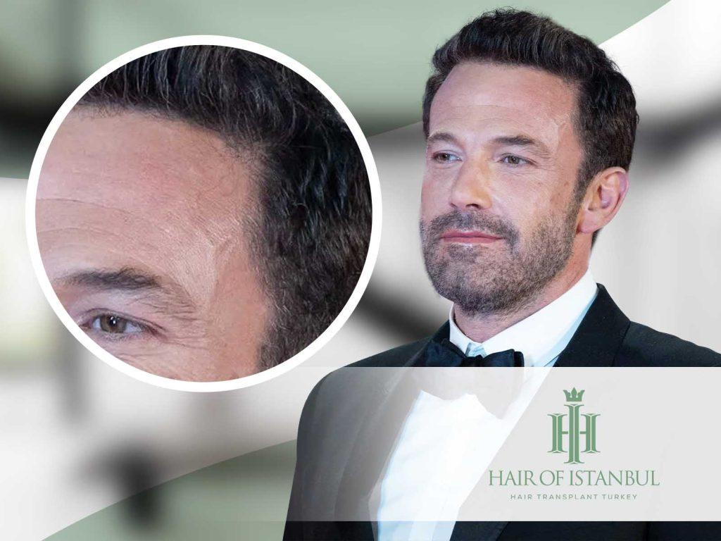 ben affleck hair transplant