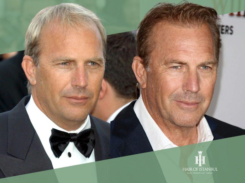 Kevin Costner Hair Transplant