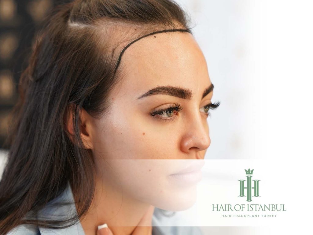 Female Hair Transplant Recovery: What Differs for Women