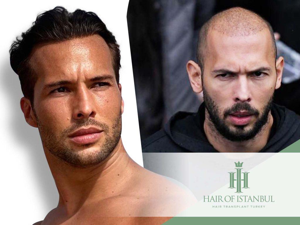Tristan Tate Hair Transplant