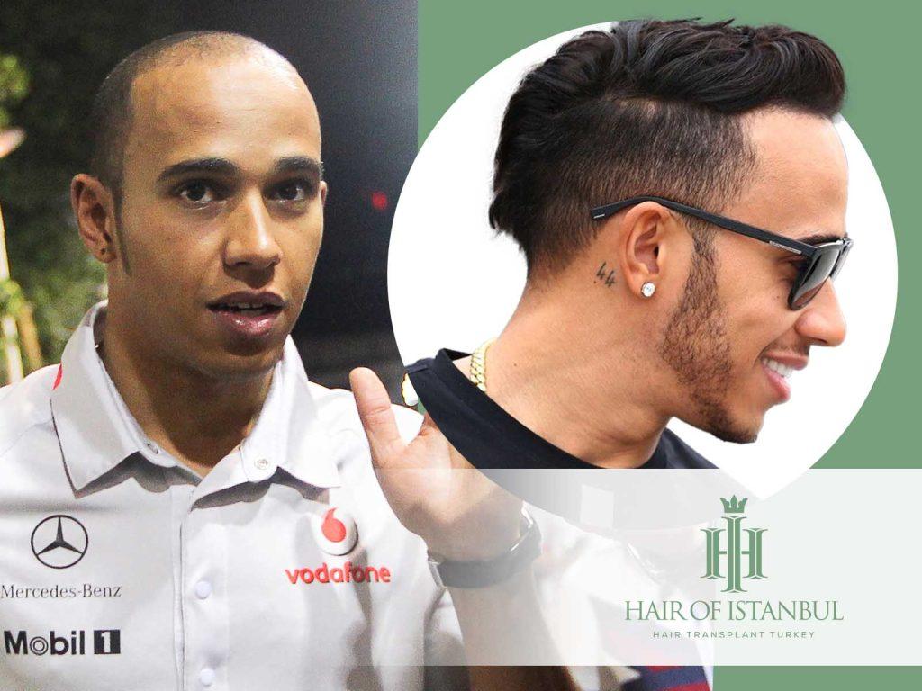 lewis hamilton hair transplant