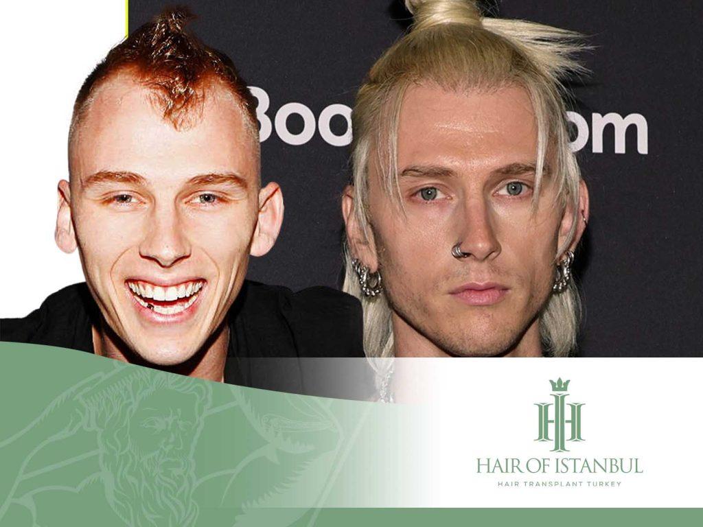 Machine Gun Kelly’s Hair Transplant