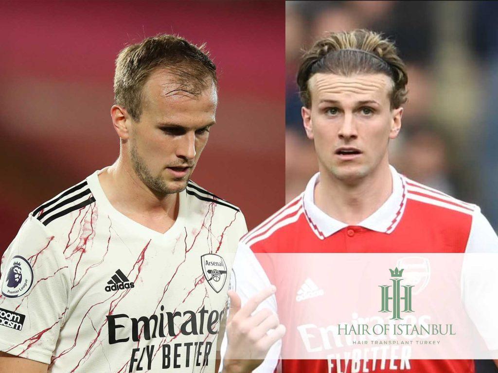 Rob Holding Hair Transplant
