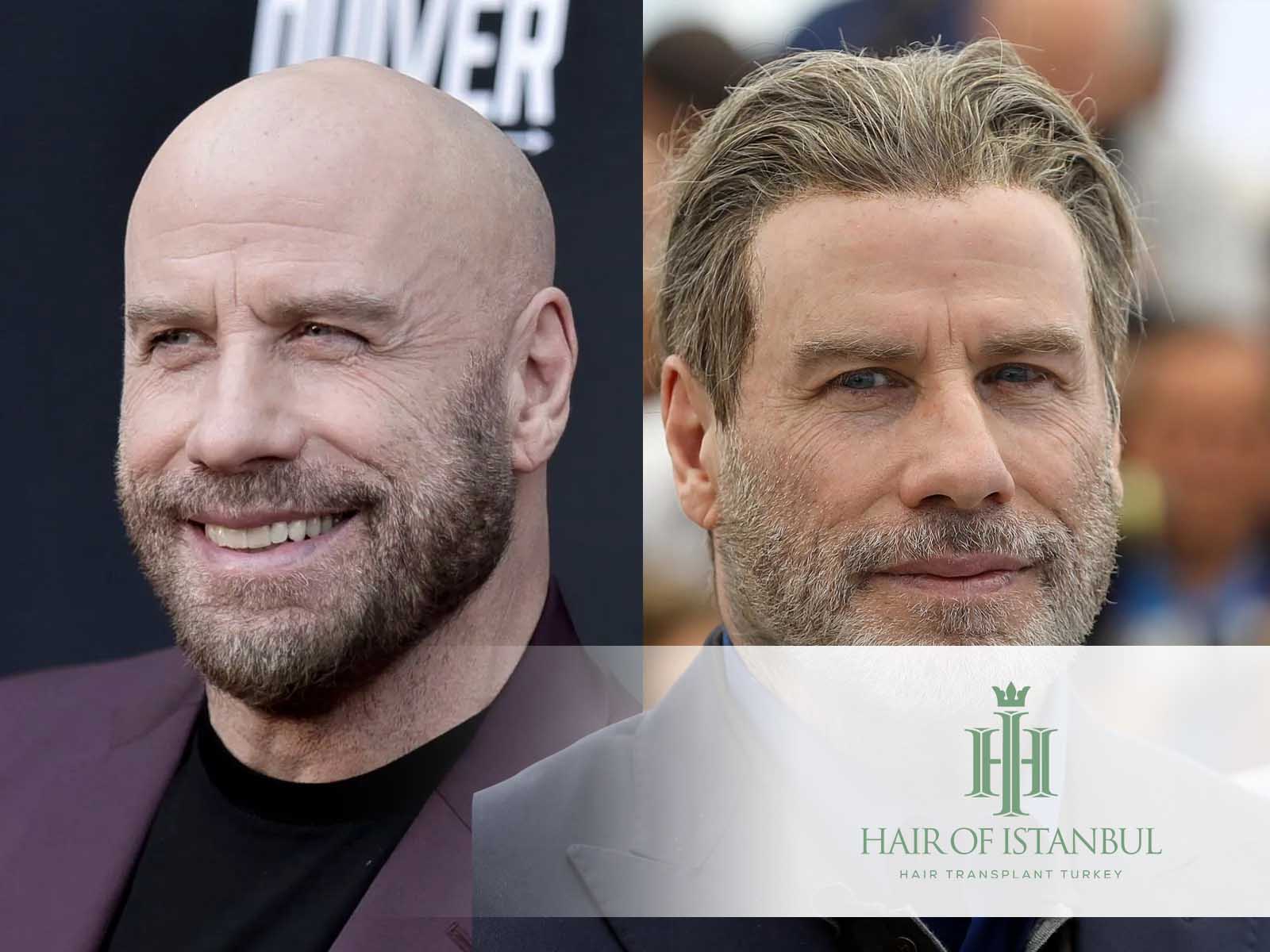 John Travolta Hair Transplant: An In-Depth Investigation!