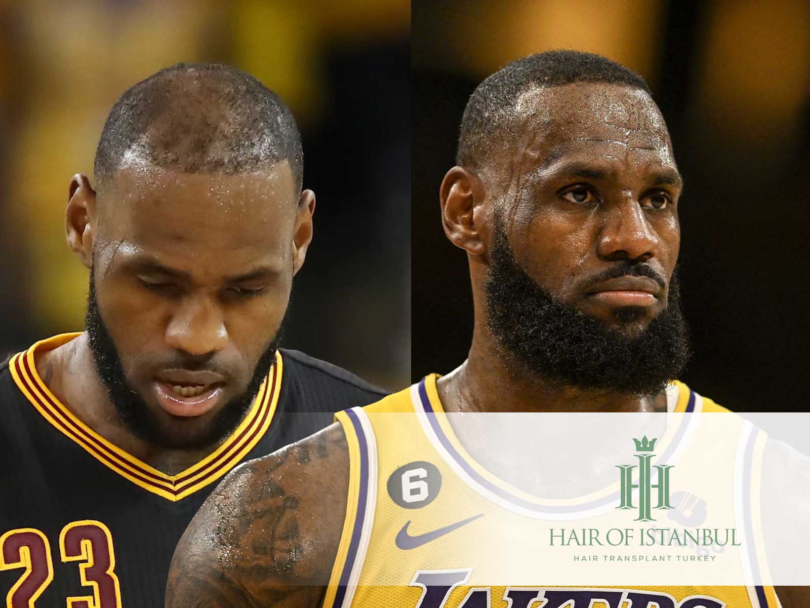 Greffe de cheveux de LeBron James : vérité ou rumeur fondée ?