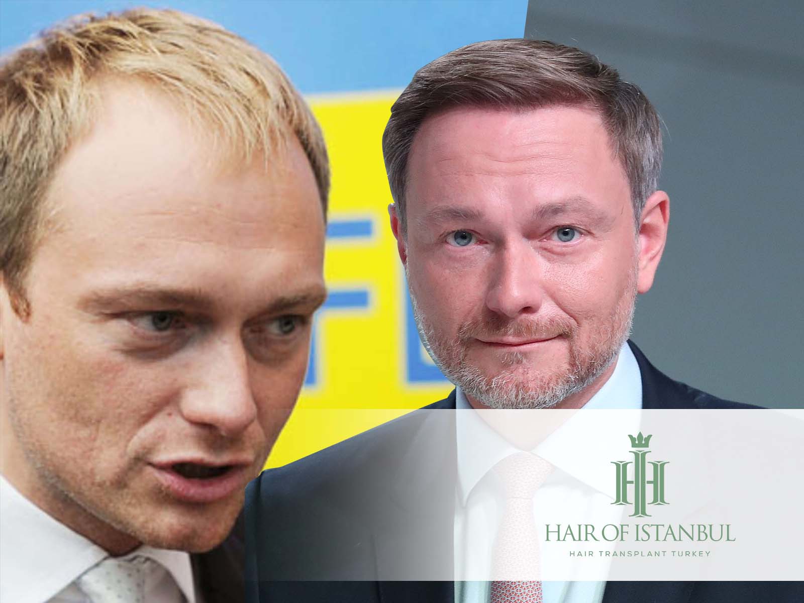 Christian Lindner Haartransplantation – Ergebnisse, Kosten und Vorher-Nachher-Bilder