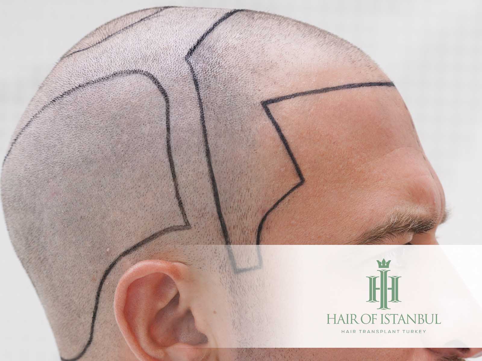 Haartransplantation bei Geheimratsecken: Alles Wissenswerte!