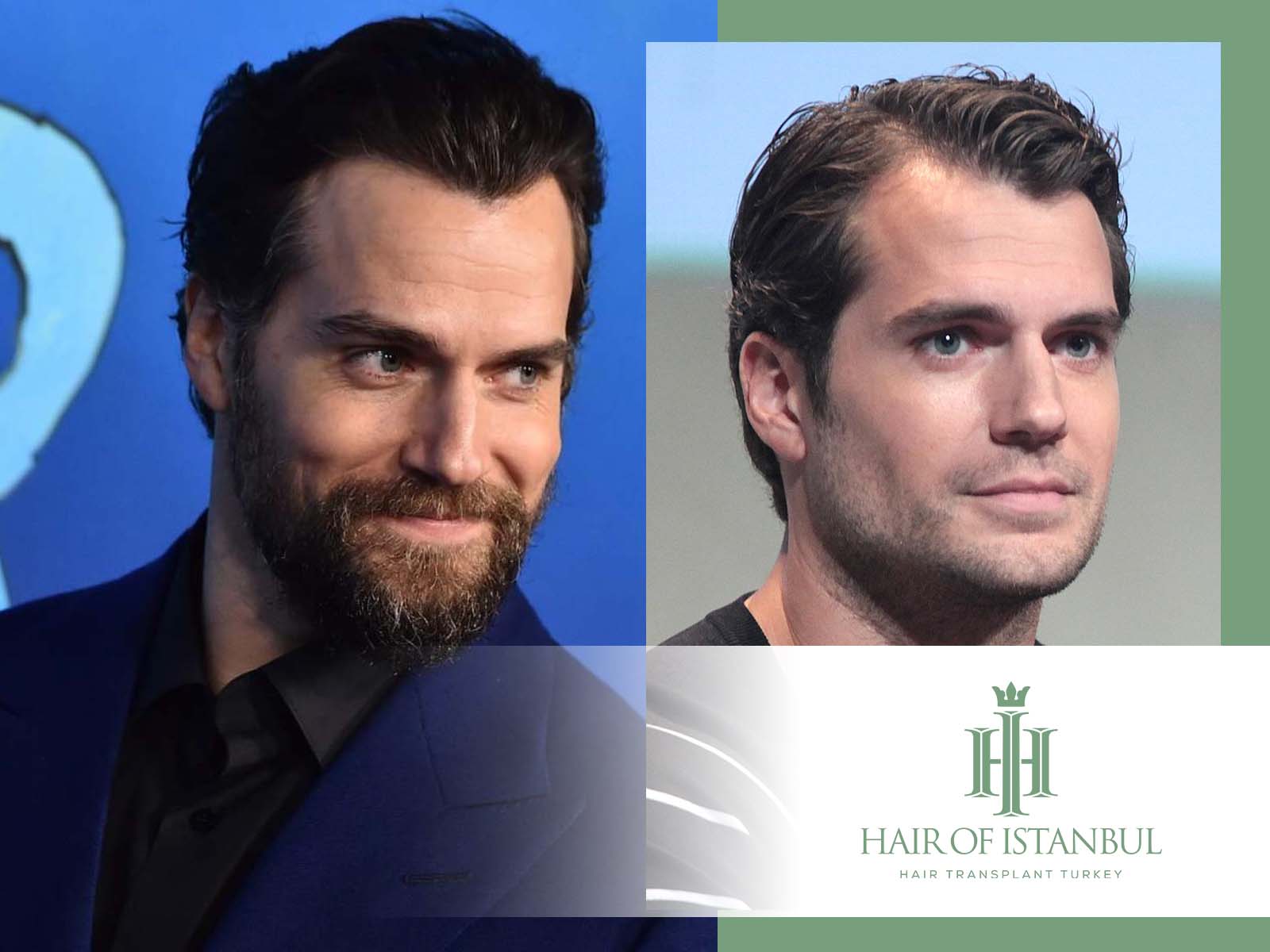 Henry Cavill Hair Transplant: From Superman to Super Hair