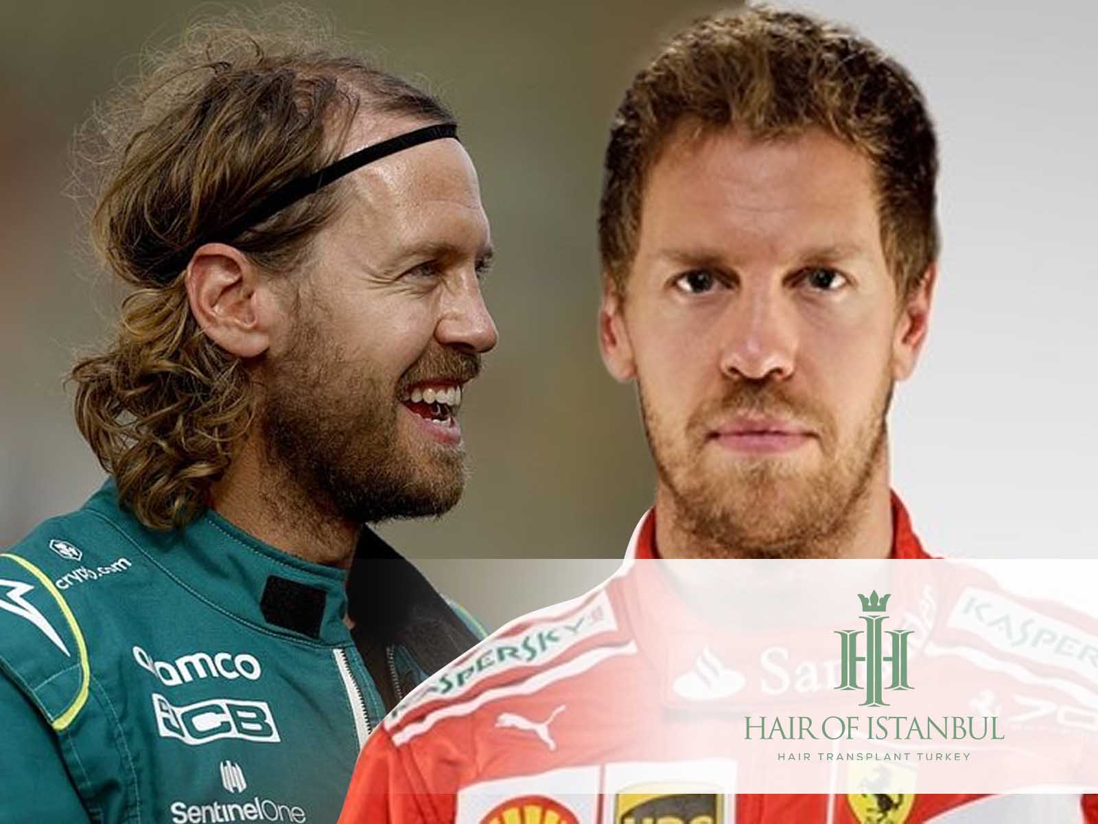 Sebastian Vettel Haartransplantation – Ergebnisse, Vorher-Nachher-Fotos und Expertenmeinungen