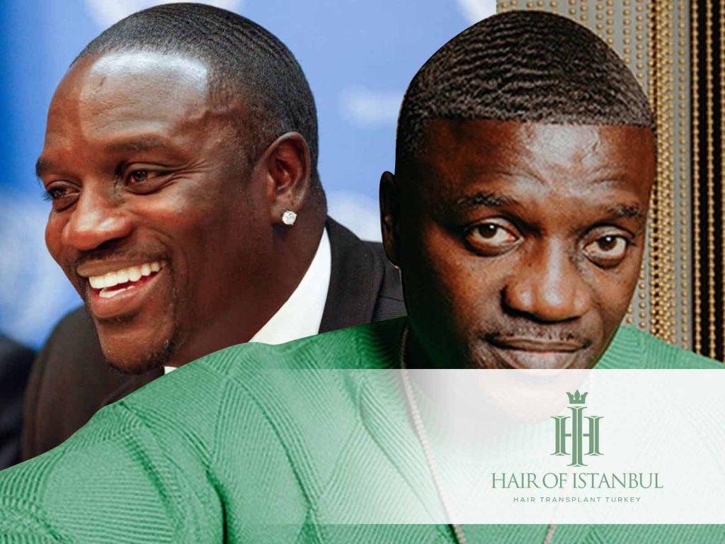 Akon Hair Transplant A Deep Dive into His New Hair