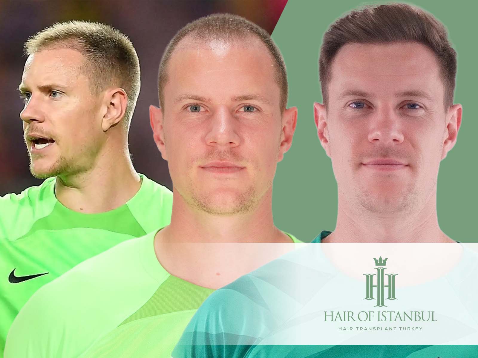 Ter Stegen Haartransplantation – Transformation, Vorher-Nachher-Ergebnisse und Kosten