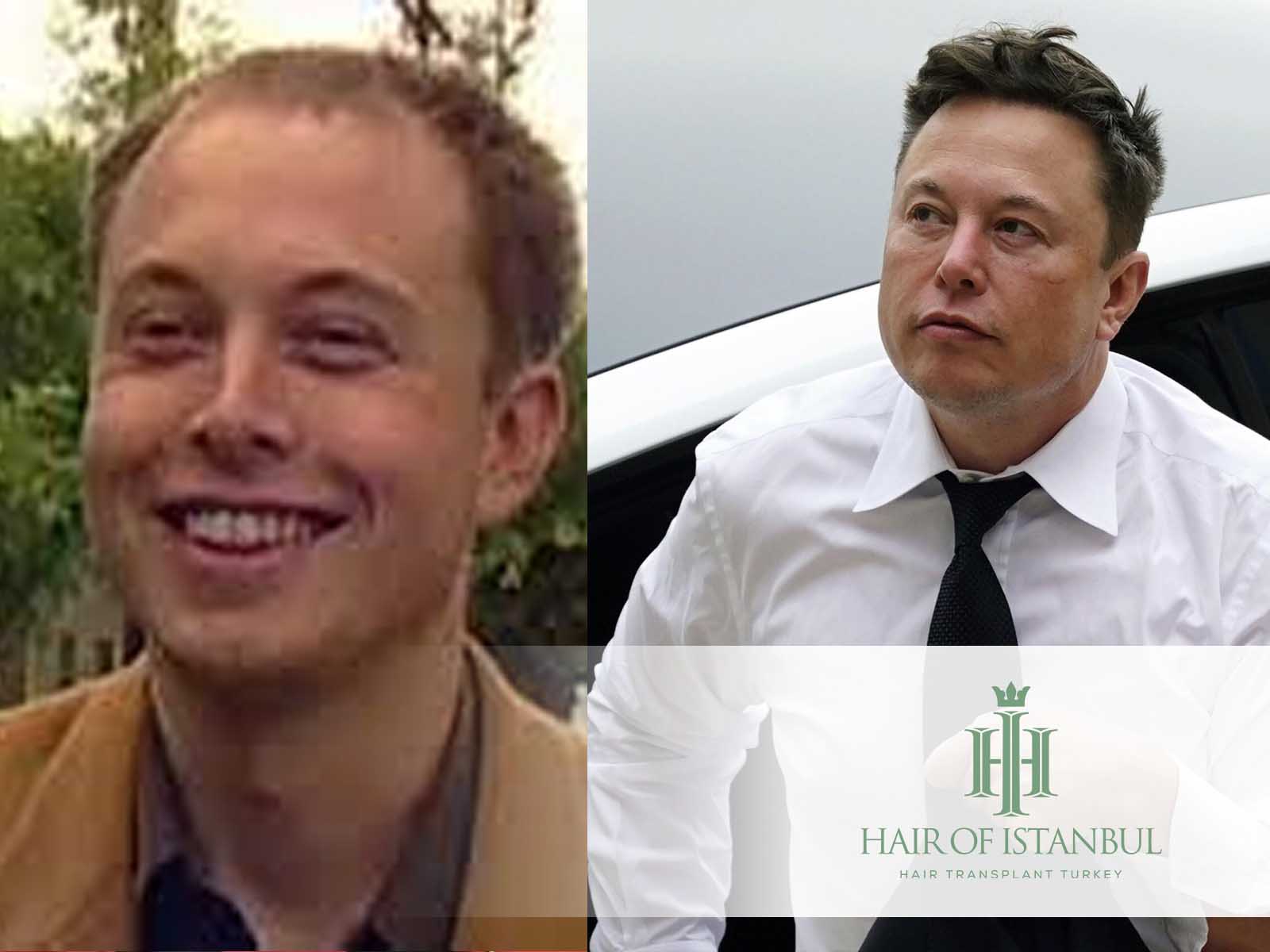 Elon Musk Haartransplantation: Haare wieder im Rampenlicht