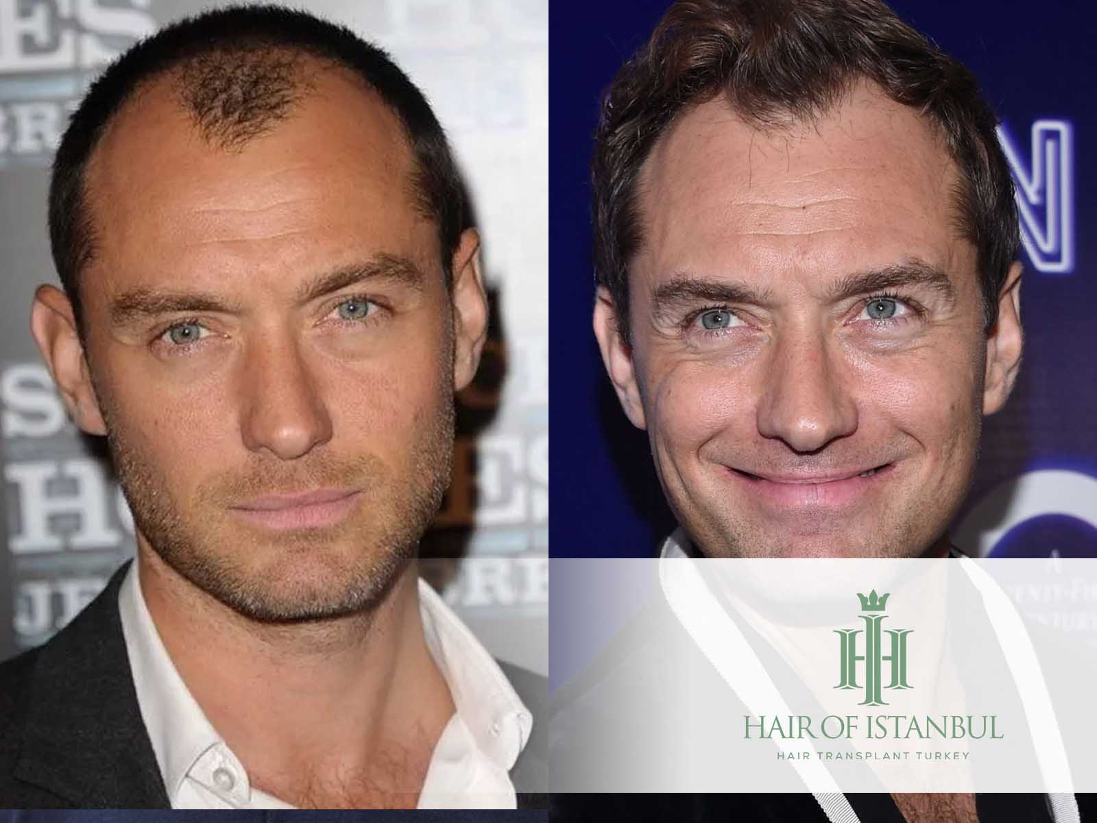 Jude Law Hair Transplant: The Real Story Behind the Locks