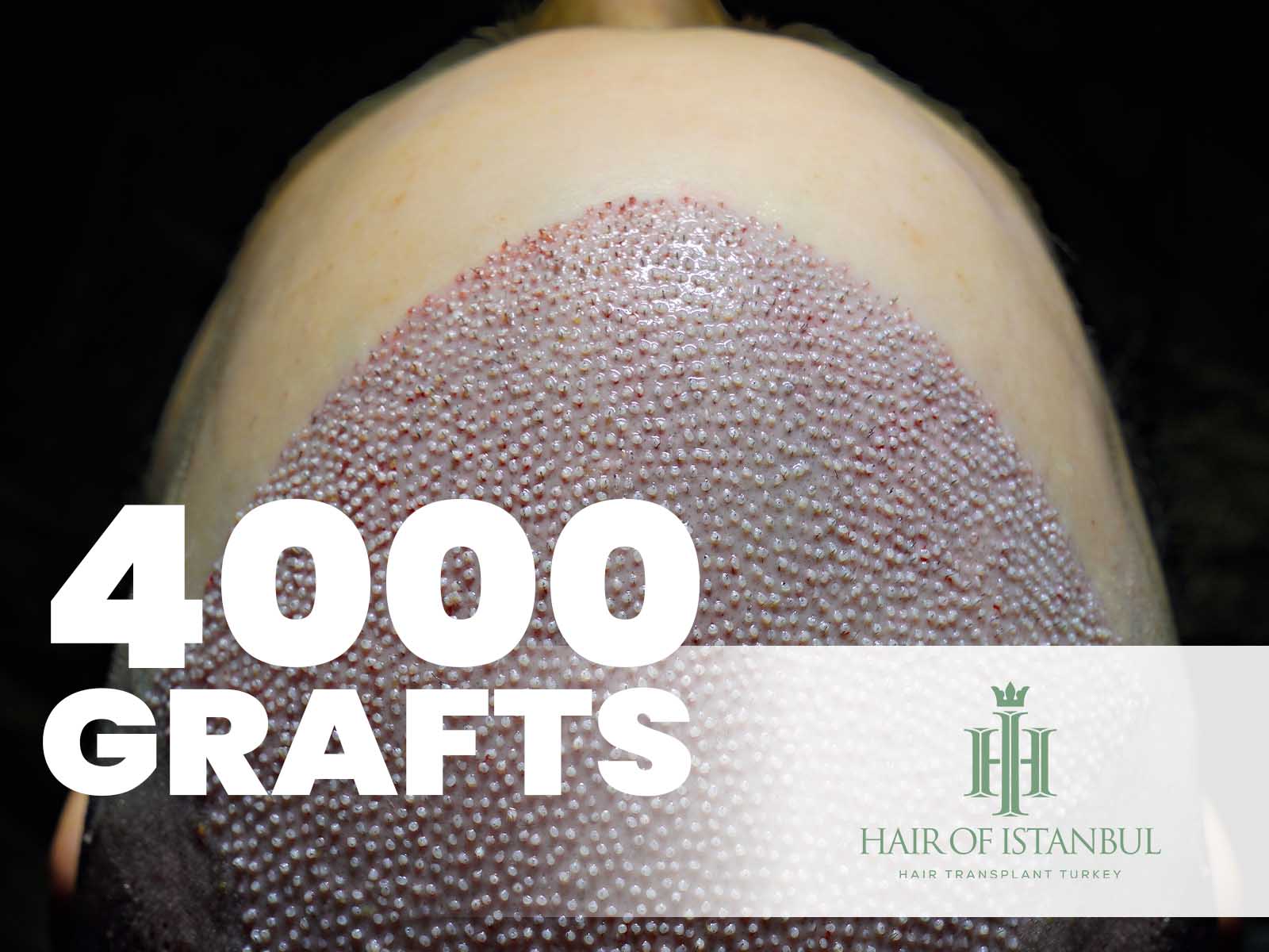 4000 Grafts Haartransplantation – Kosten, Vorher Nachher Bilder