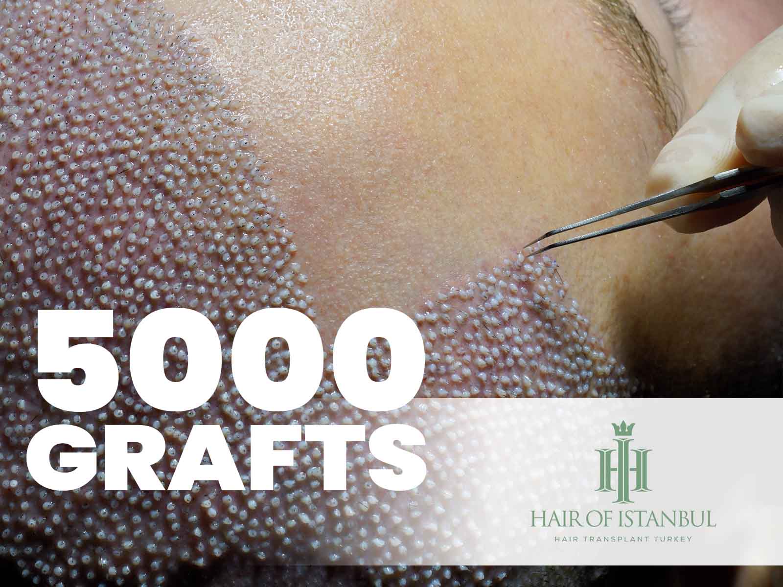 5000 Grafts Haartransplantation – Kosten, Vorher Nachher Bilder