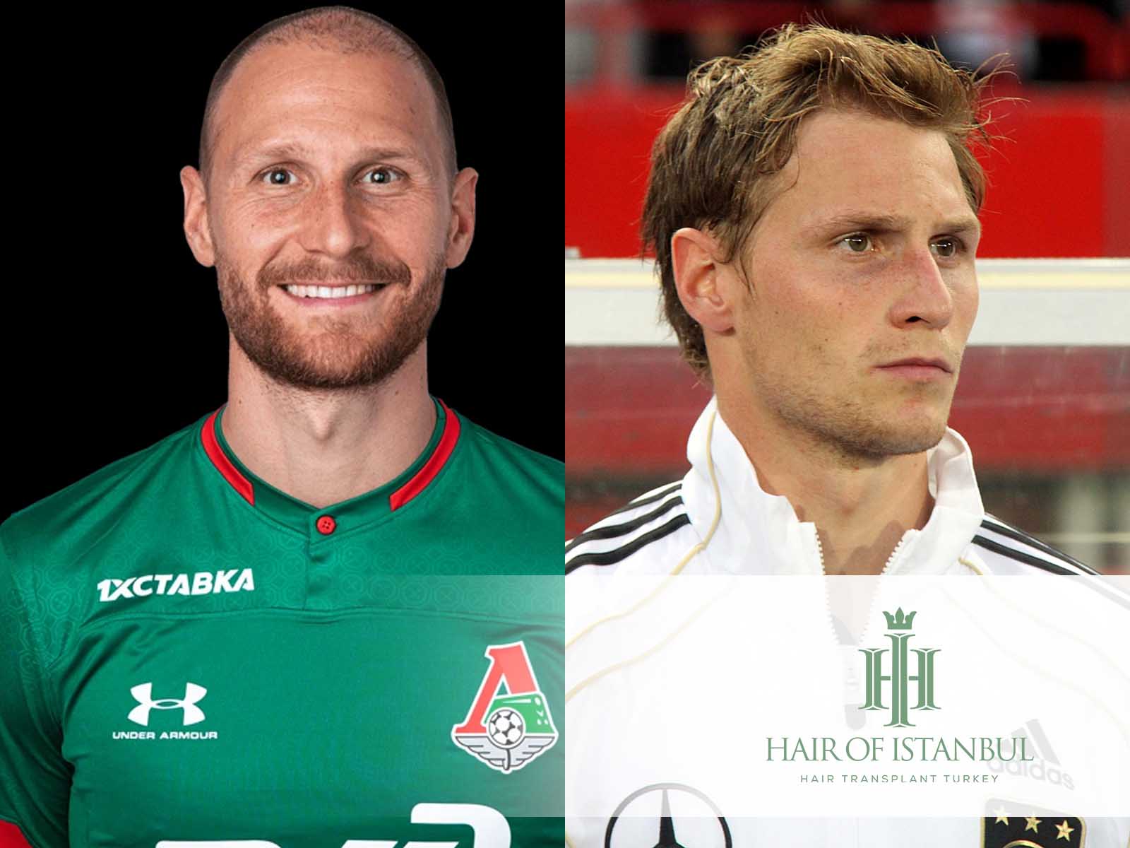 Benedikt Höwedes Haartransplantation – Geheimnis seiner Haare