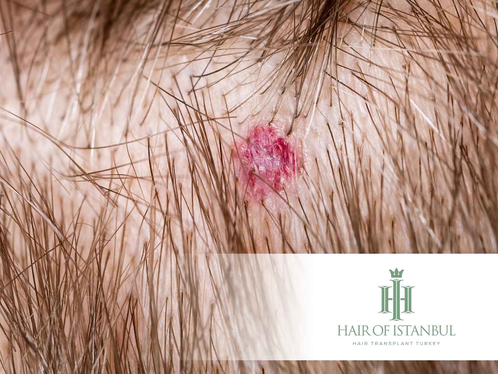 Pickel auf der Kopfhaut Nach einer Haartransplantation: Normal?