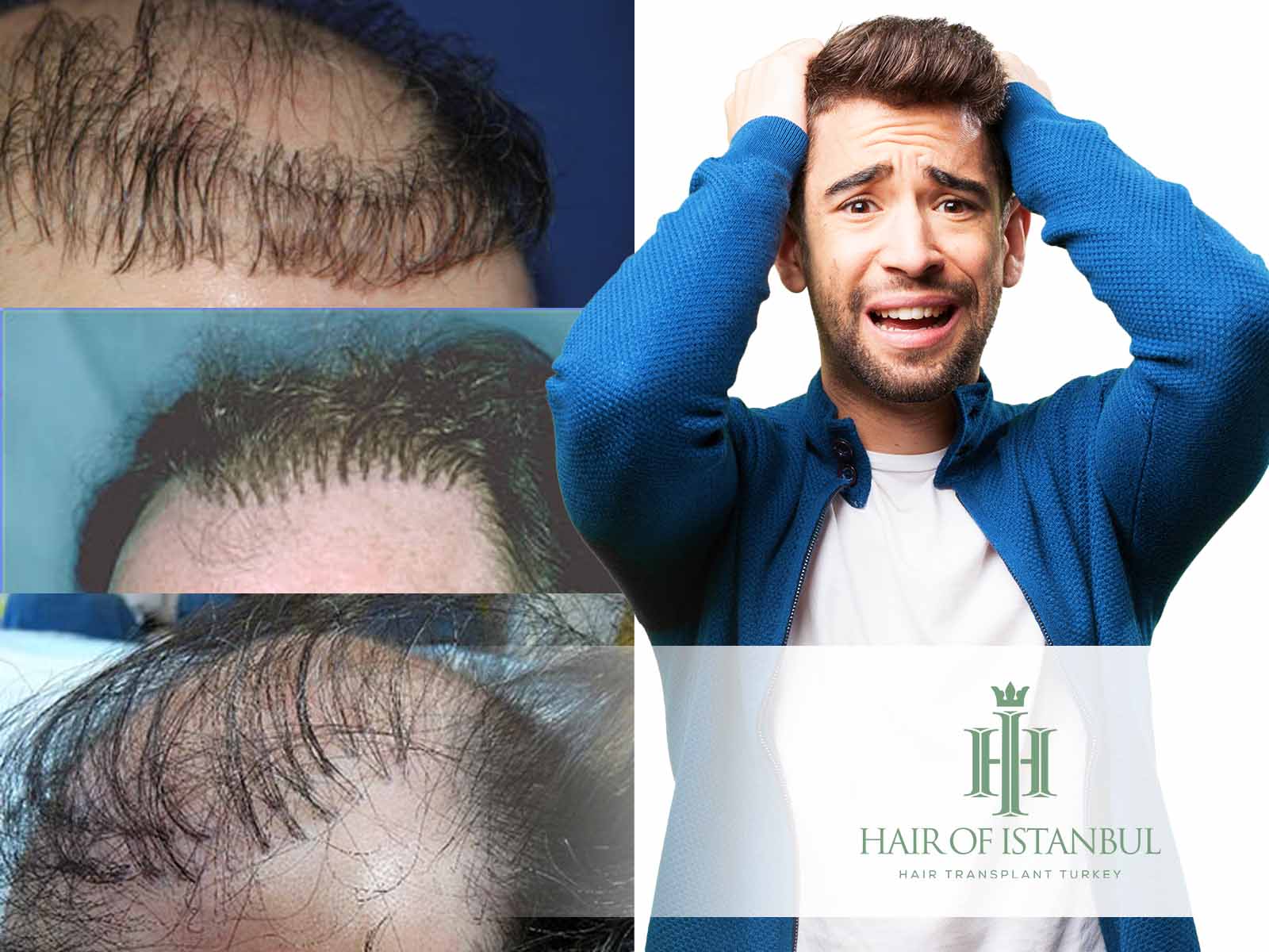 Haartransplantation negative Erfahrungen: Wie vermeiden?