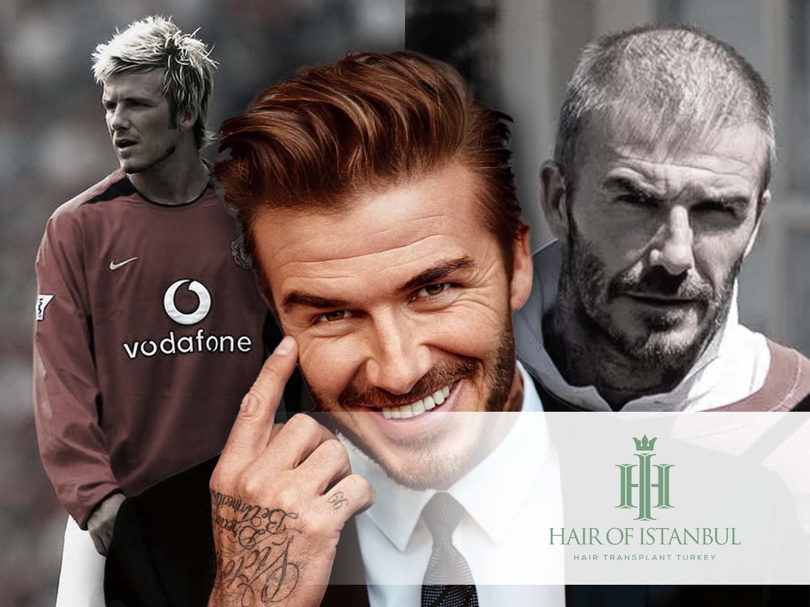 David Beckham Haartransplantation: Alle Fakten im Überblick