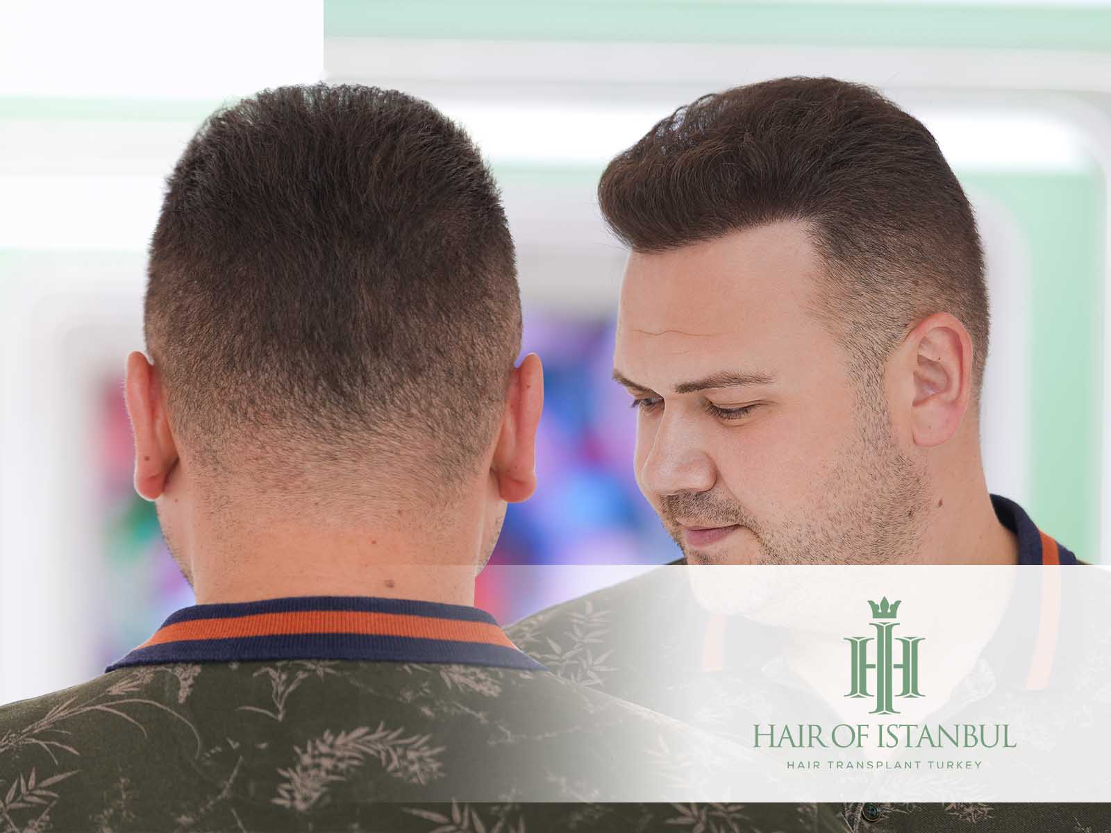 Spenderbereich nach Haartransplantation: Was ist zu erwarten?