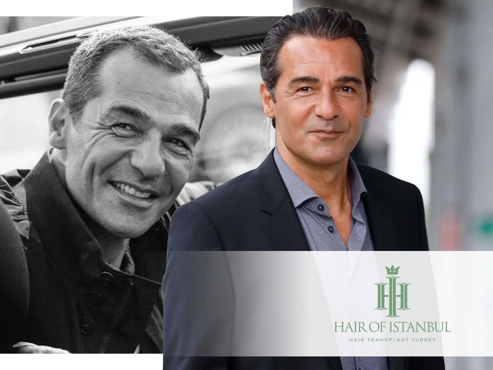 Erol Sander und das Rätsel seiner dichten Haare: Haartransplantation?